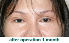 plastic-surgery-blepharoplasty